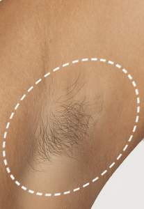 Underarm Hair Removal – Mave IPL Device Real Results